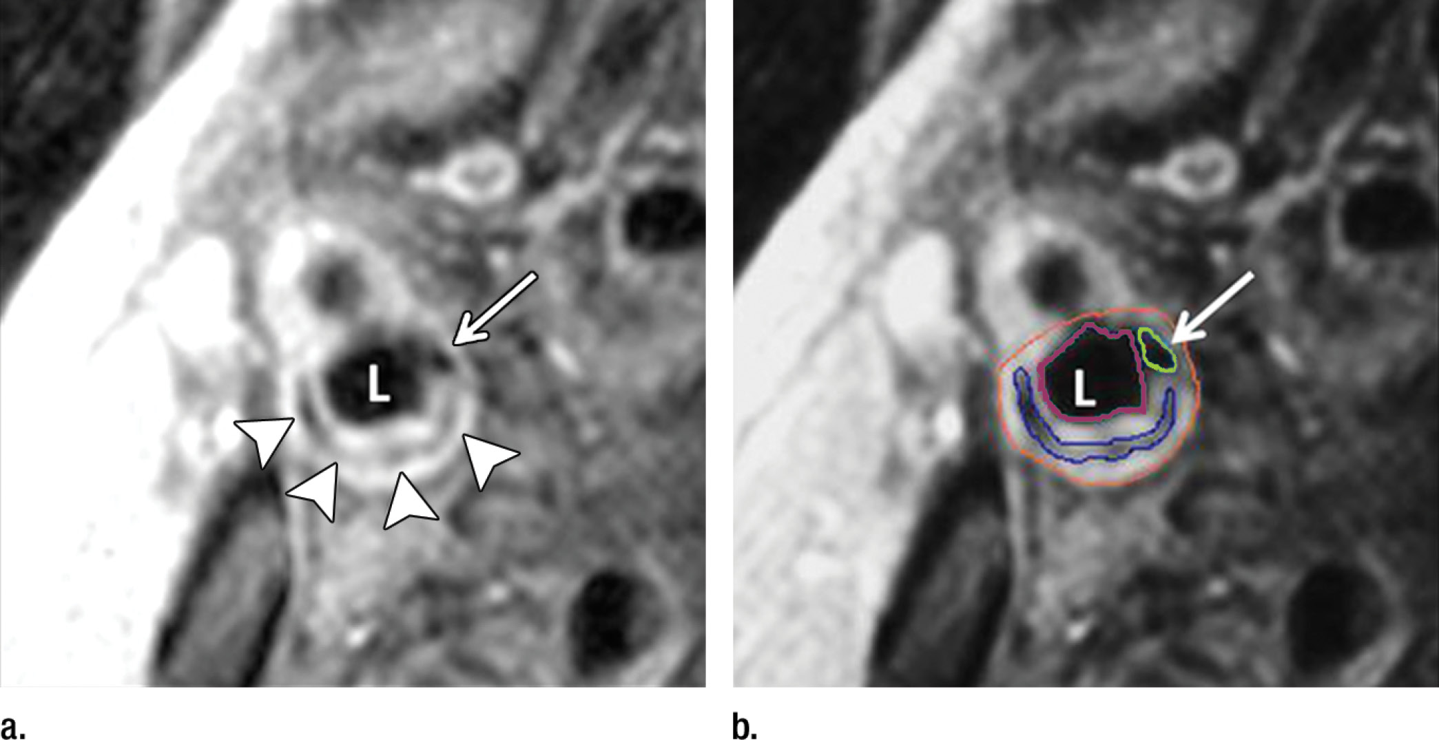 Images show axial spin-echo proton density of the substantia nigra (SN) (on the right) and gradient-recalled echo (GRE) (on the left)